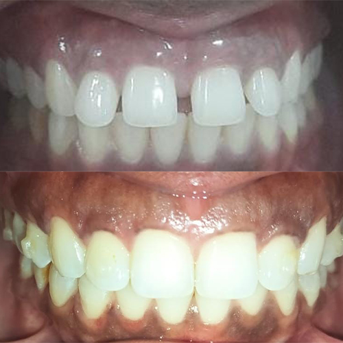 Composite veneers