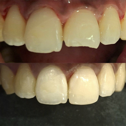 Composite veneers