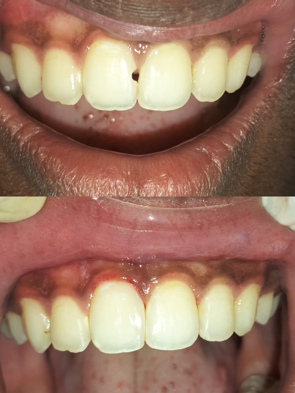 Composite Veneer