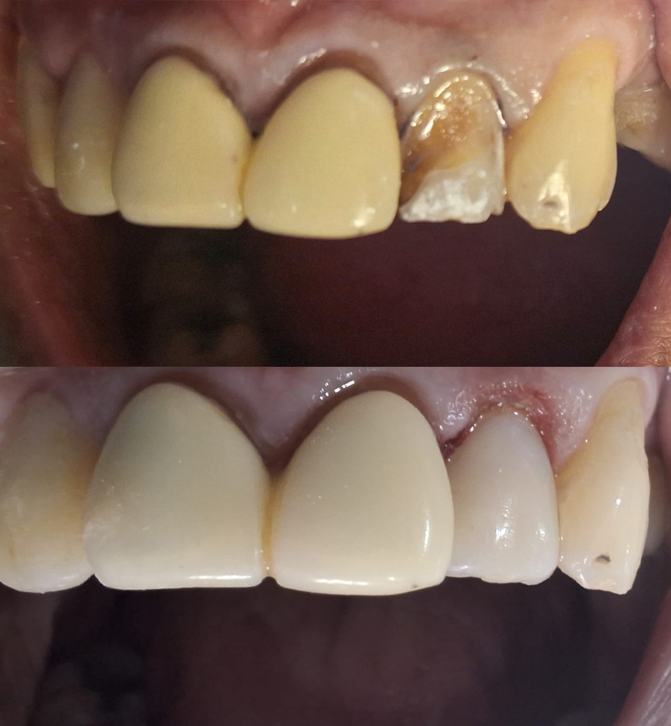 Composite restoration