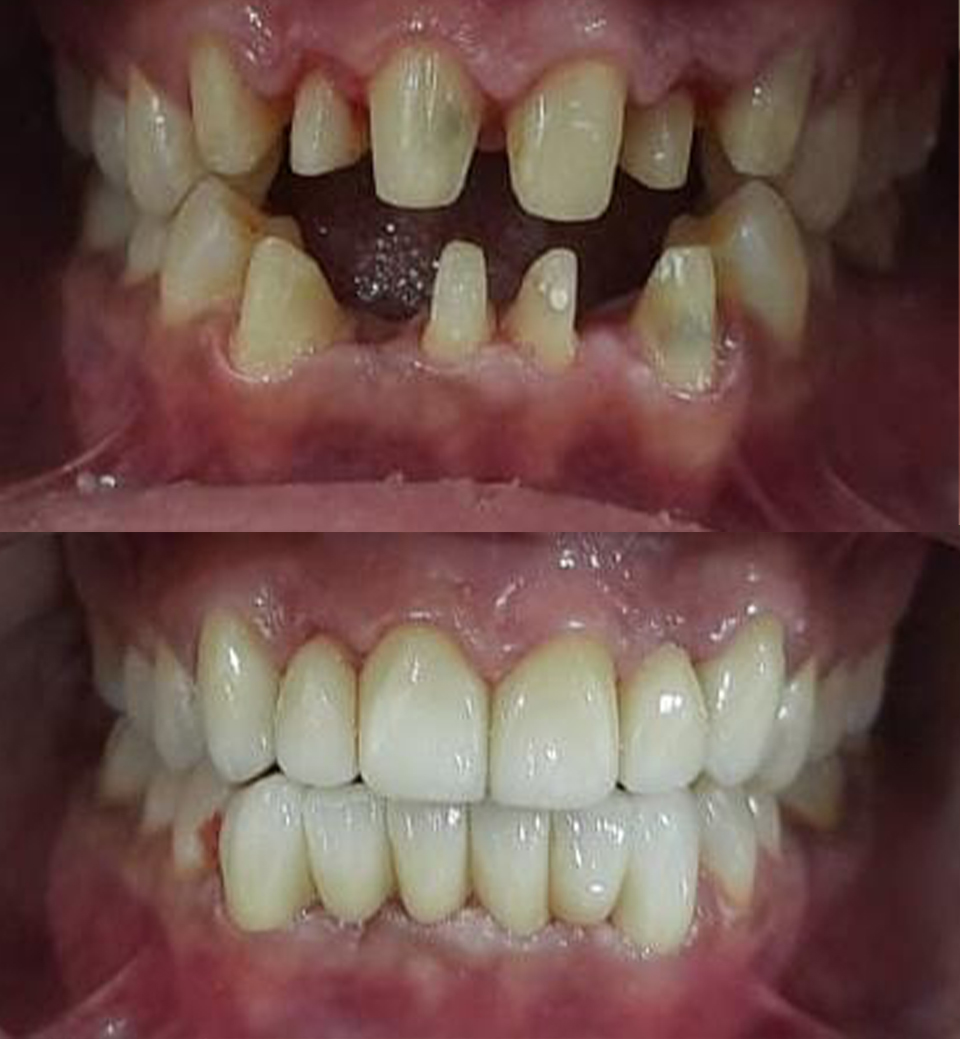 Smile correction